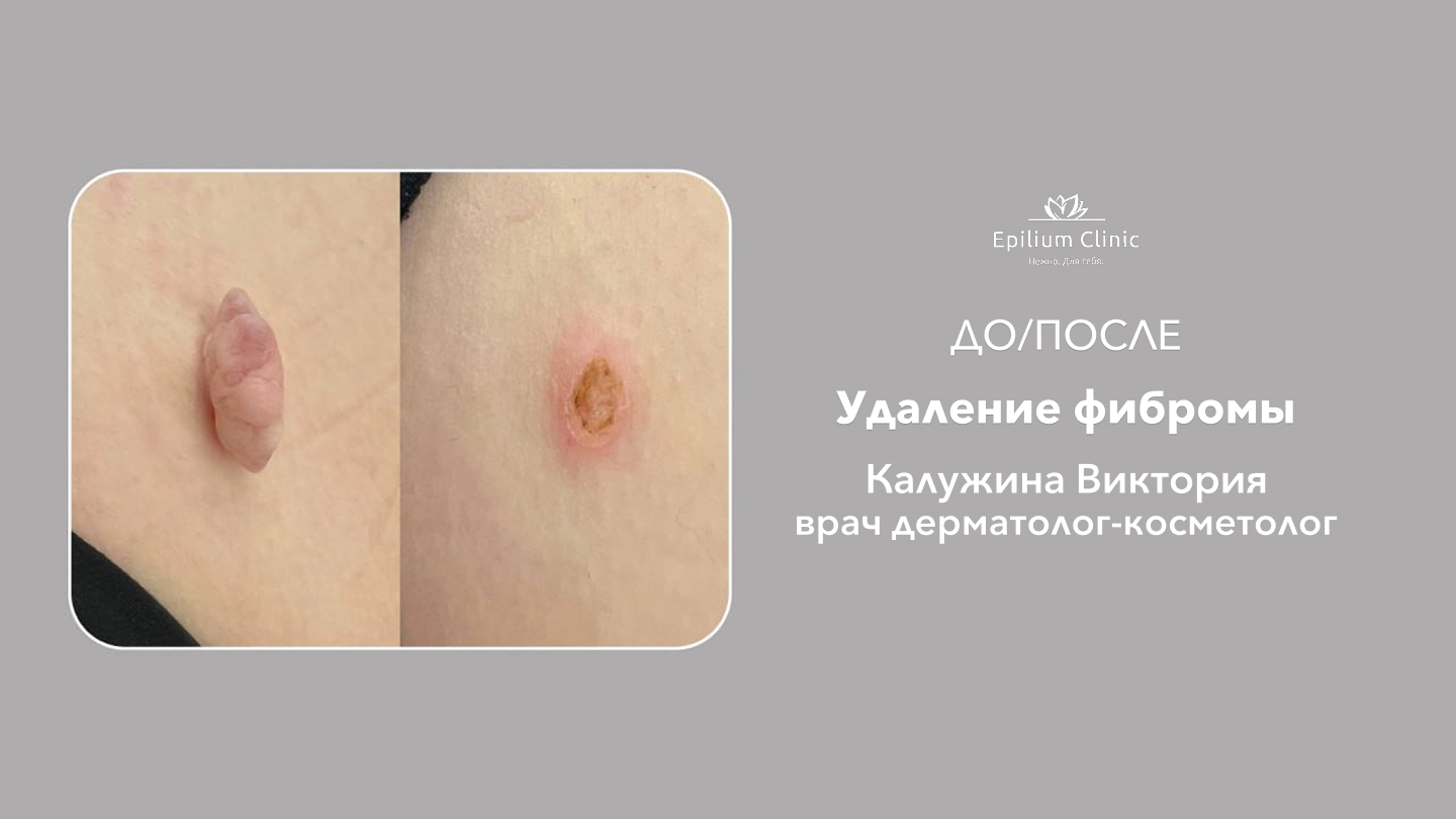 32_Удаление фибромы_Калужина