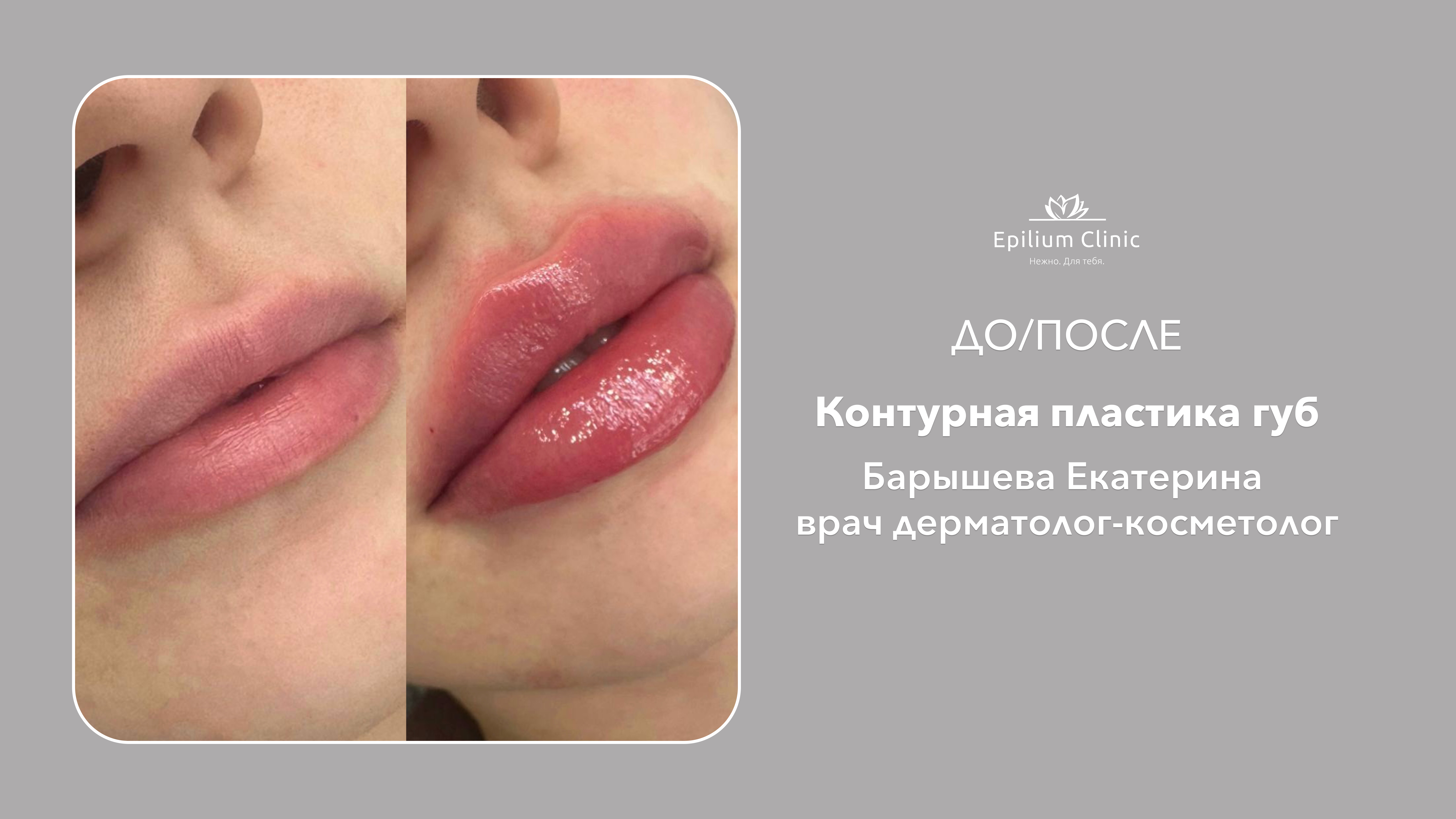 20_контурная пластика губ_Барышева