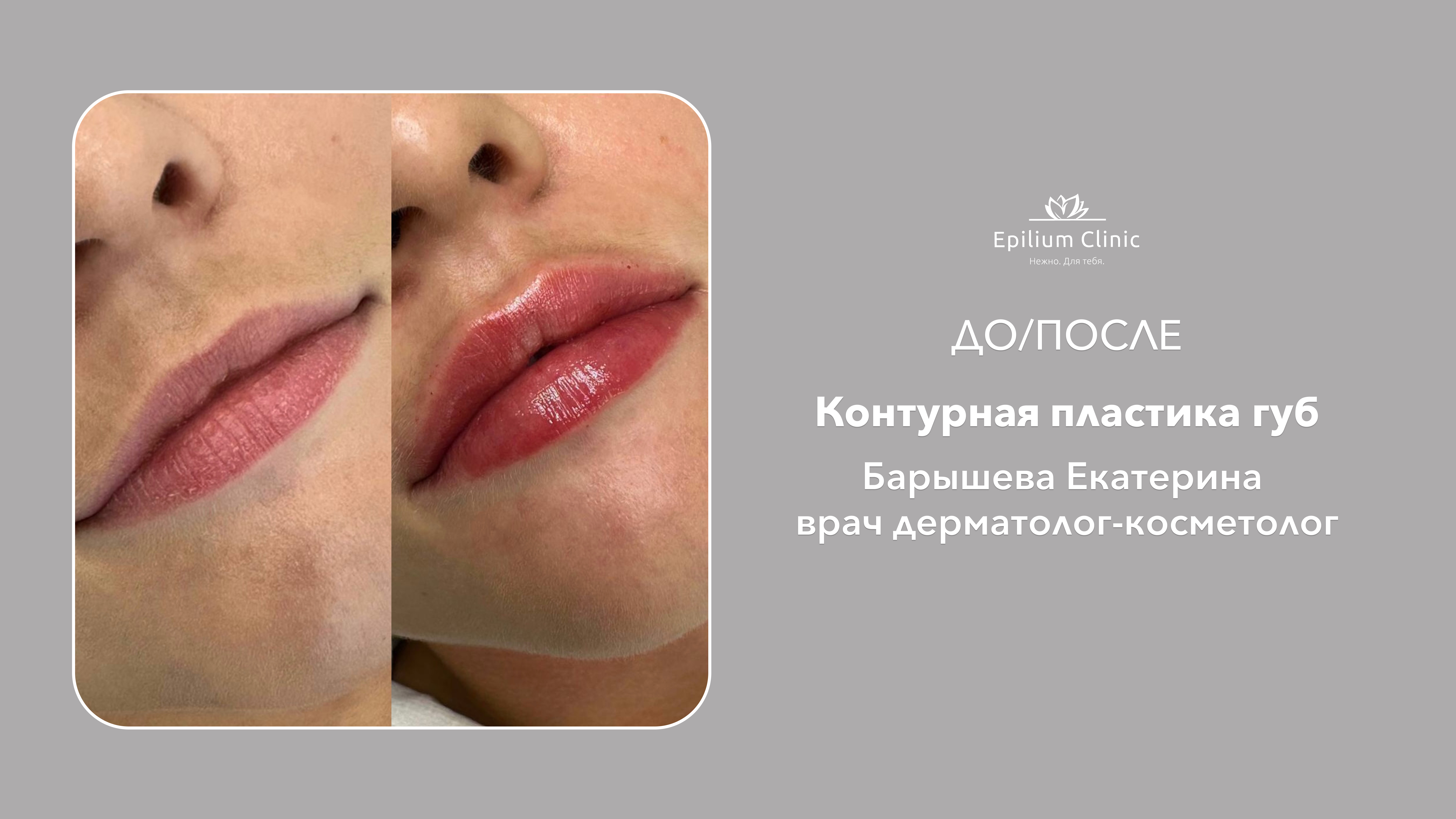 25_контурная пластика губ_Барышева
