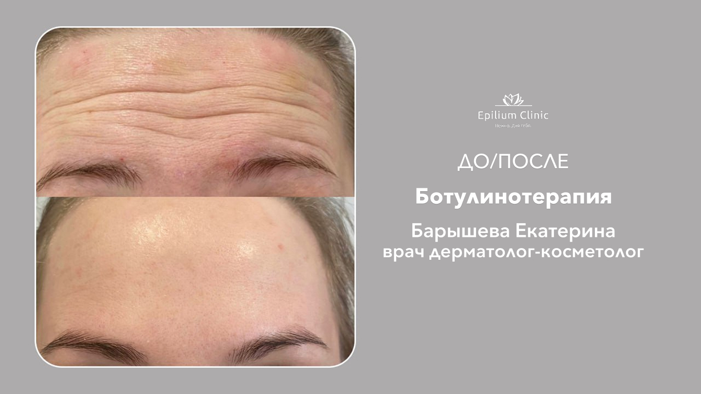 26_ботулинотерапия_Барышева