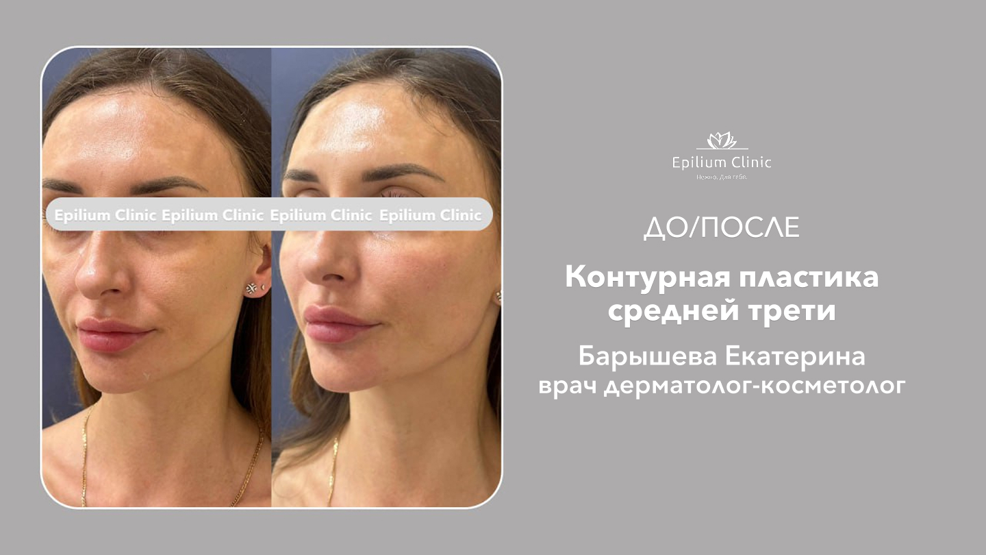 35_контурная пластика средней трети_Барышева